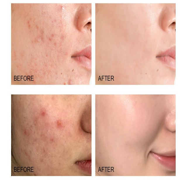 مصل حب الشباب